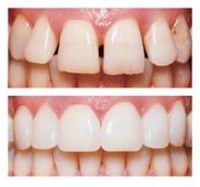 If you’re dissatisfied with your smile because of chipped or misshapen teeth, gaps or permanent staining, porcelain veneers can be just the solution you’re looking for.